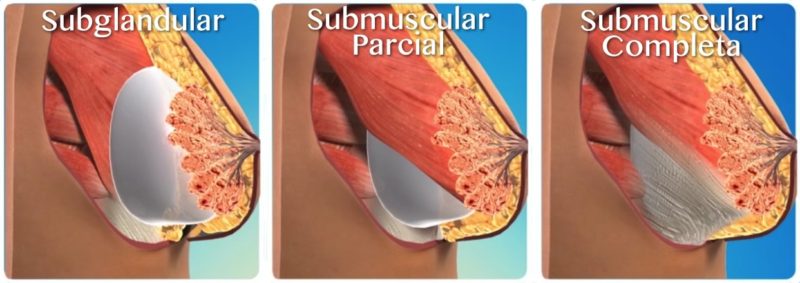 Subglandular Submuscular Parcial Submuscular Completa